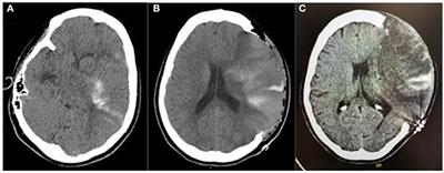 Case Report: Decompressive Craniectomy for COVID-19 Malignant Cerebral Artery Infarction. Is Surgery a Good Option?